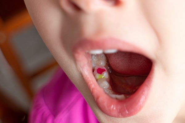 How A Tooth Filling Is Done